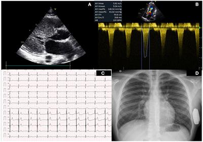 Case report: Removal of a subcutaneous implantable cardiac defibrillator in a pediatric patient with hypertrophic cardiomyopathy after a septal myectomy. Insights on current indications of type of ICD in children with hypertrophic cardiomyopathy and left ventricular tract obstruction